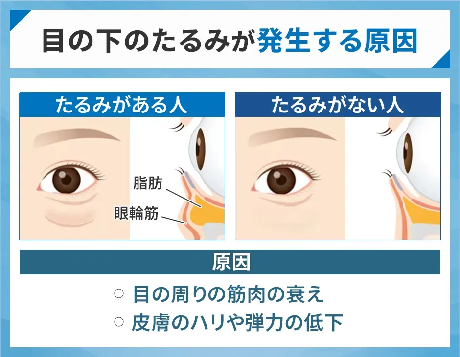 目の下のたるみが発生する原因